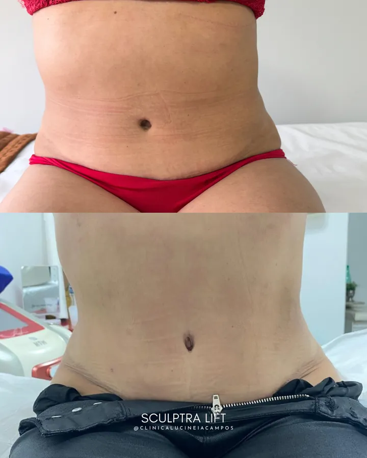 Antes (acima) e depois (abaixo): abdômen em vista frontal.