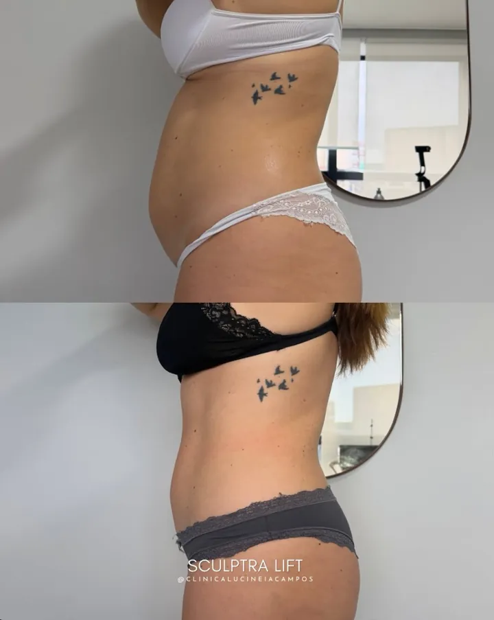 Antes (acima) e depois (abaixo): abdômen em vista lateral.